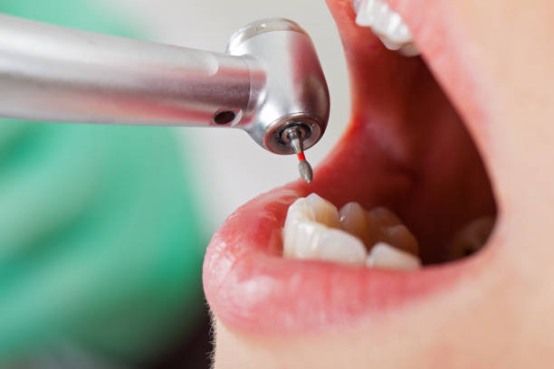 Best Emergency Tooth Extraction in Newark, OH